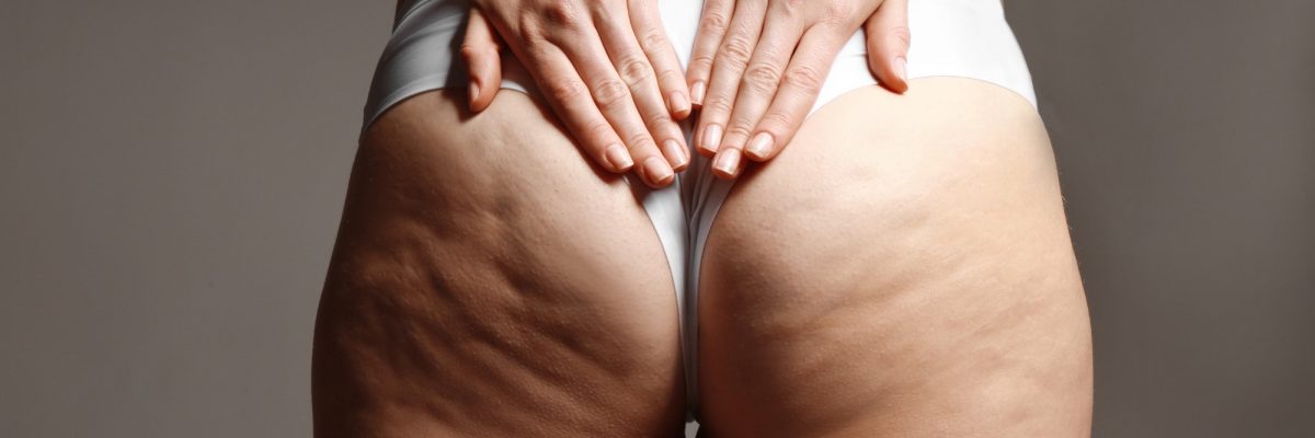 qwo injectables for cellulite treatment orange county